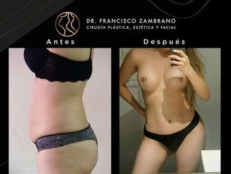 Liposucción antes y después - 881314