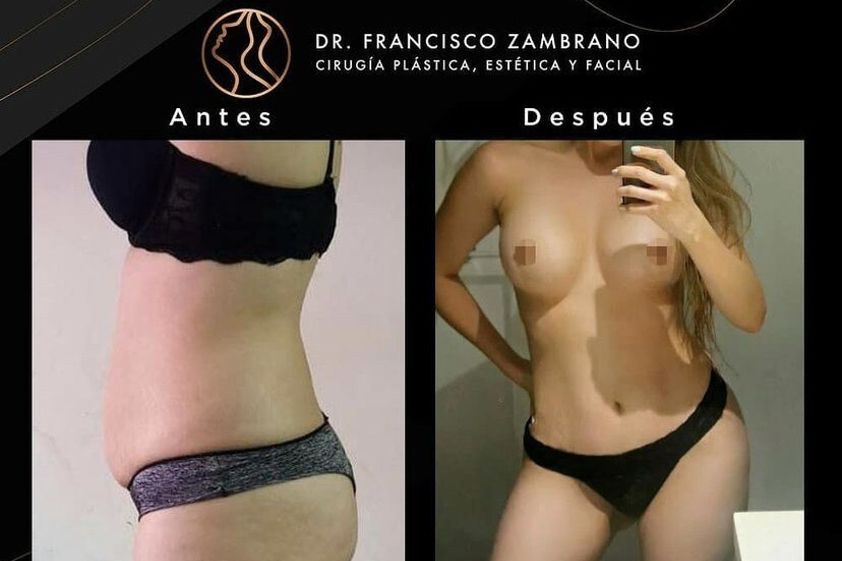 Liposucción antes y después - 881314