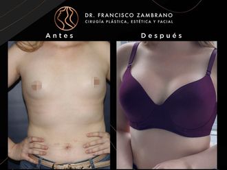 Mamoplastia de aumento antes y después - 881315