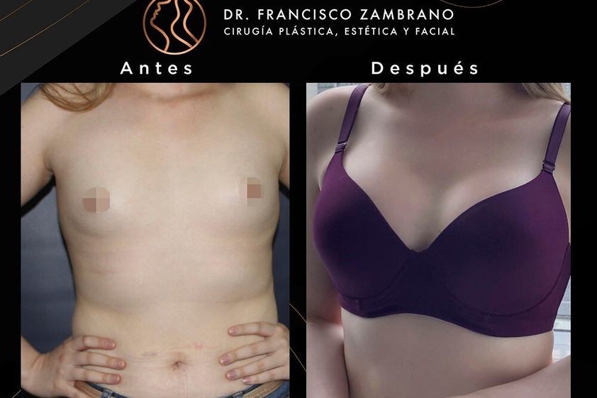 Mamoplastia de aumento antes y después - 881315