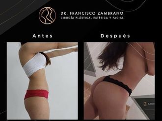 Gluteoplastia antes y después - 881316