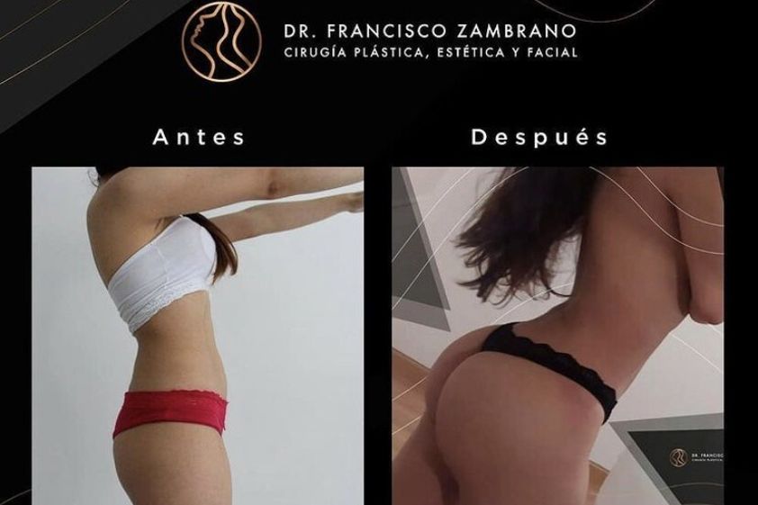 Gluteoplastia antes y después - 881316