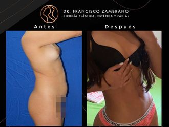 Lipoescultura antes y después - 881317