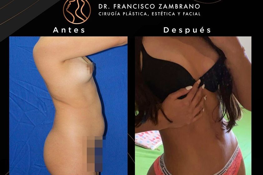 Lipoescultura antes y después - 881317