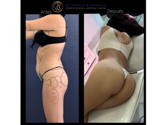Lipoescultura antes y después - 881586