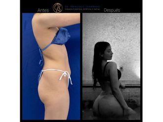 Lipoescultura antes y después - 881587