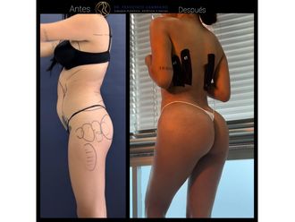 Gluteoplastia antes y después - 881588
