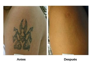 Remoción tatuajes