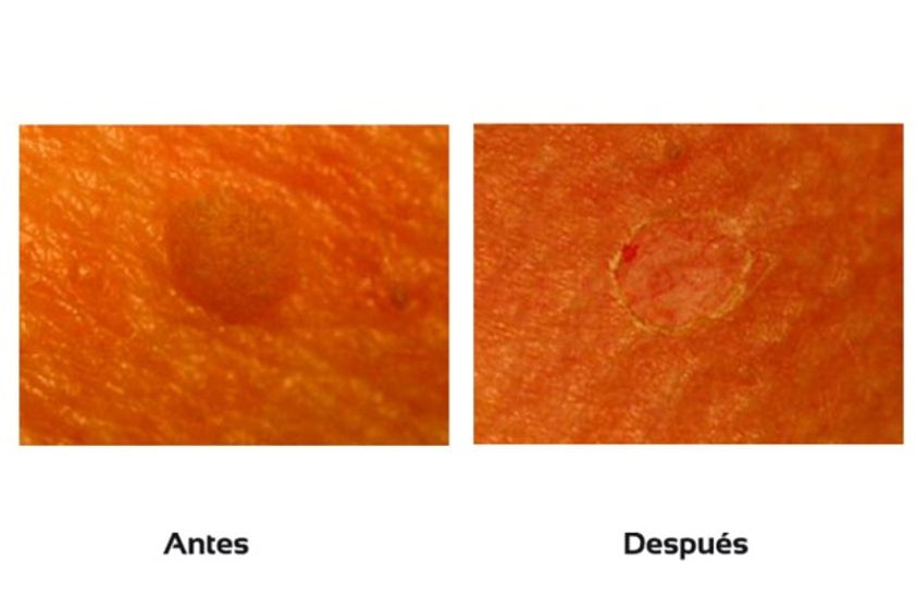 Lunares antes y después - 510421