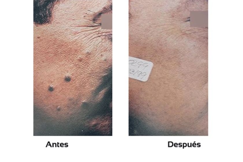 Lunares antes y después - 510423