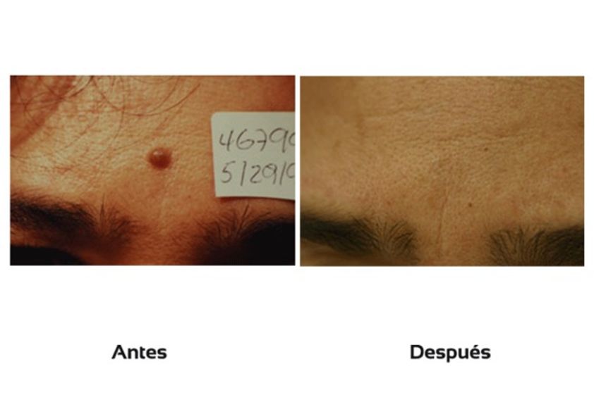 Lunares antes y después - 510424