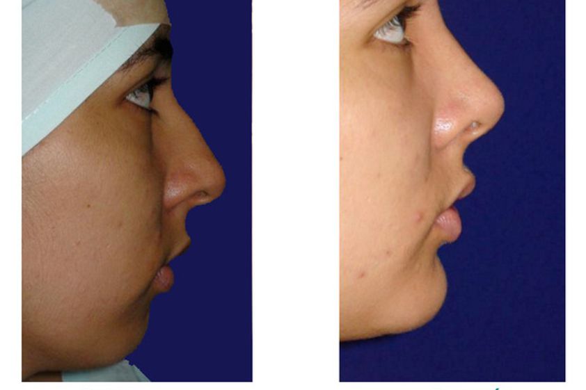 Rinoplastia antes y después - 516434