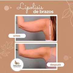 Lipolisis de brazos - Salmaclinic by Dra Marinela Perrony