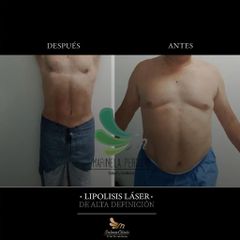 Lipolisis Láser - Salmaclinic by Dra Marinela Perrony