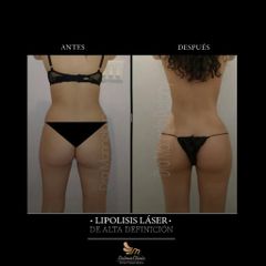 Lipolisis Láser - Salmaclinic by Dra Marinela Perrony