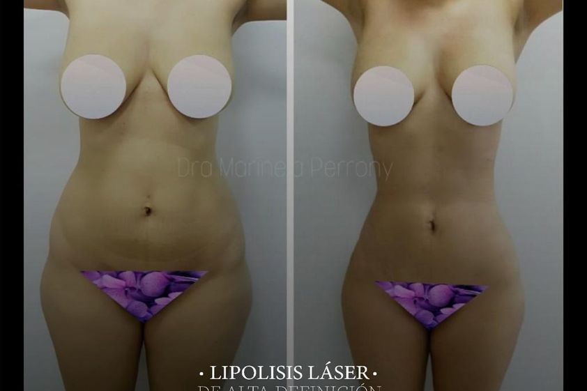 Lipólisis láser antes y después - 812190