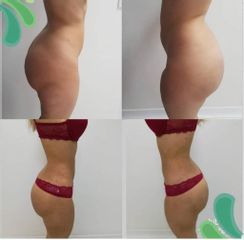 Liposucción - Salmaclinic by Dra Marinela Perrony