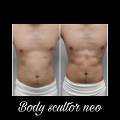 Lipólisis Láser - Salmaclinic by Dra Marinela Perrony