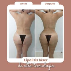 Lipólisis Láser - Salmaclinic by Dra Marinela Perrony