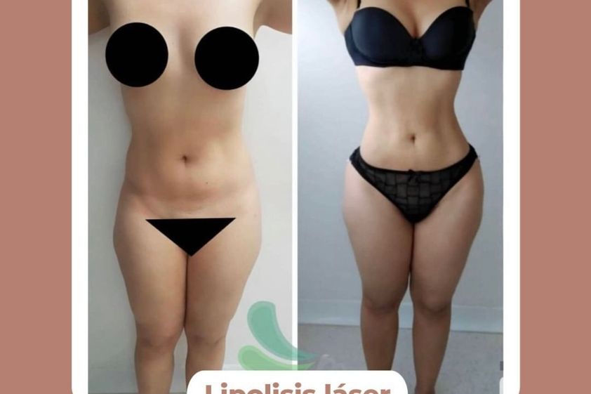 Lipólisis láser antes y después - 814272