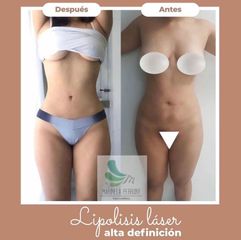 Lipolisis laser alta definición - Salmaclinic by Dra Marinela Perrony