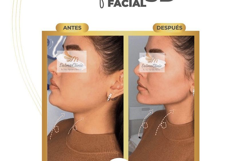 Cirugía de papada antes y después - 858319