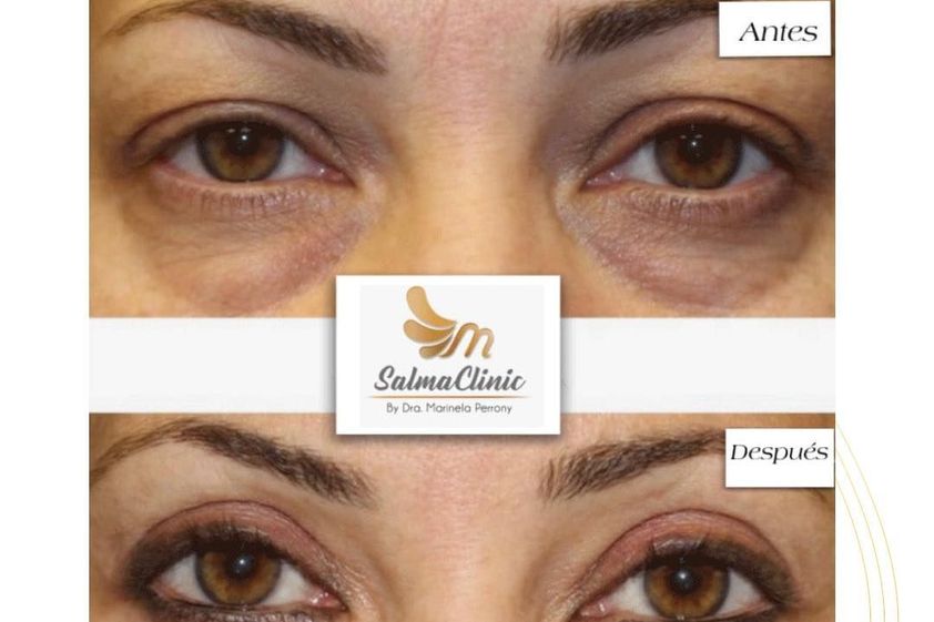 Blefaroplastia antes y después - 858320