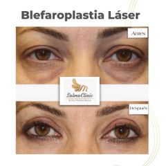 Blefaroplastia - Salmaclinic by Dra Marinela Perrony