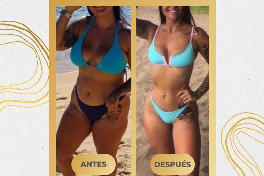Lipólisis láser antes y después - 858321