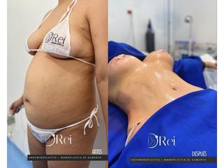 Abdominoplastia + Mamoplastia de Aumento - Dr Reinel