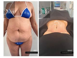Lipoabdominoplastia - Dr. Reinel Mesa