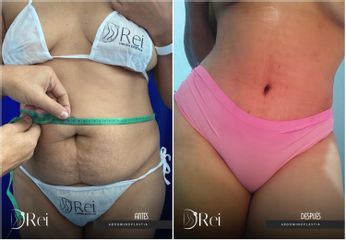 Abdominoplastia - Dr. Reinel Mesa
