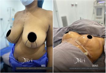 Mamoplastia de reducción - Dr. Reinel Mesa