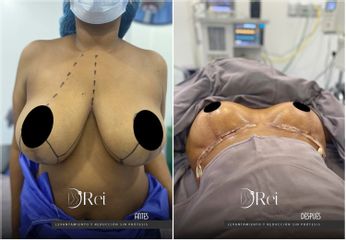 Mamoplastia de reducción - Dr. Reinel Mesa