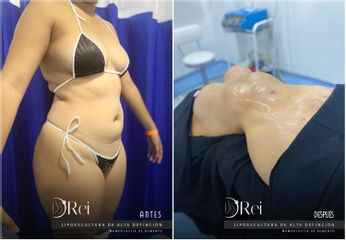 Lipoescultura - Dr. Reinel Mesa