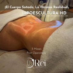 LIPOESCULTURA 360° HD + MARCACIÓN ATLETICA ABDOMINAL