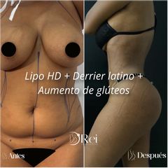 LIPOESCULURA 350° HD + SISTEMA RETRACTION + DERRIER LATINO + AUMJENTO DE GLUTEOS