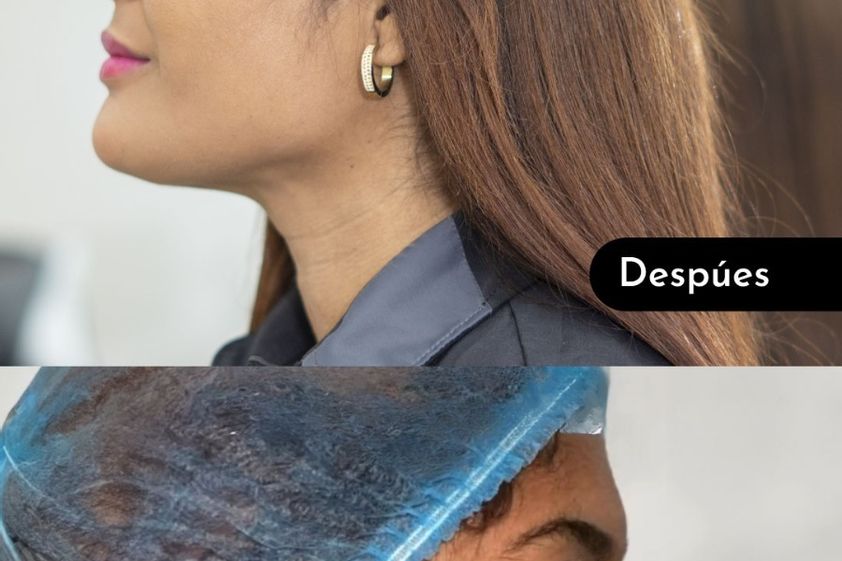 Cirugía de papada antes y después - 867342