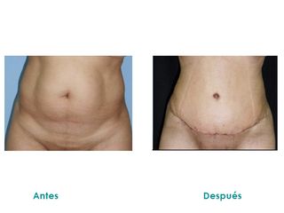 Abdominoplastia