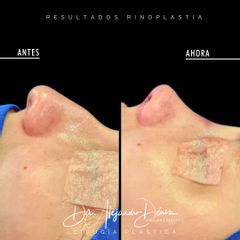 Rinoplastia - Dr. Alejandro Deniz Martínez