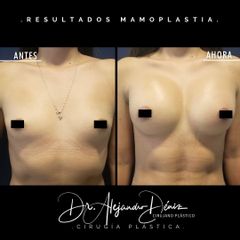 Mamoplastia de aumento - Dr. Alejandro Deniz Martínez