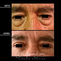 Blefaroplastia - Dr. Alejandro Deniz Martínez