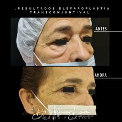 Beflaroplastia - Dr. Alejandro Deniz Martínez