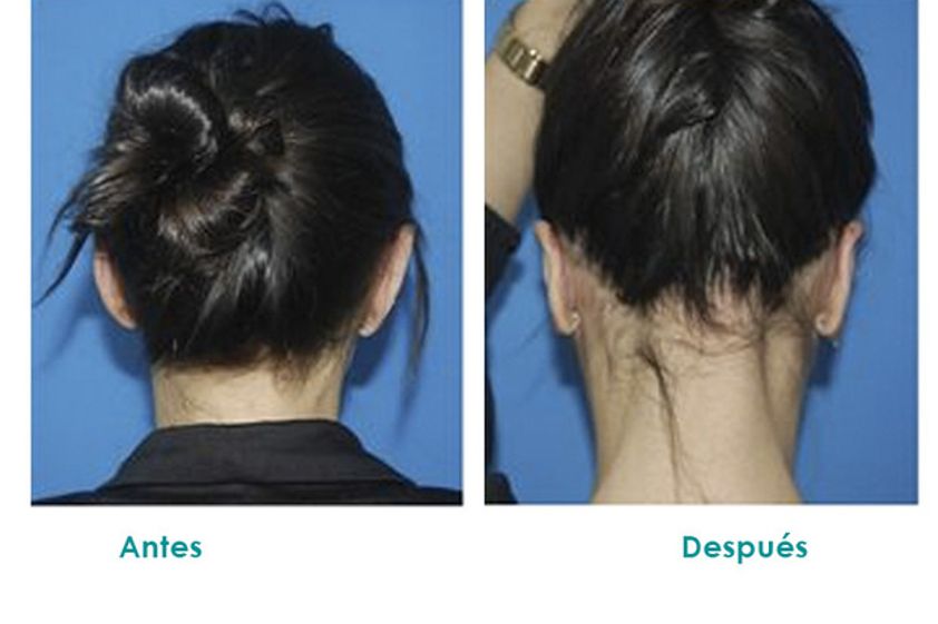 Otoplastia antes y después - 516166