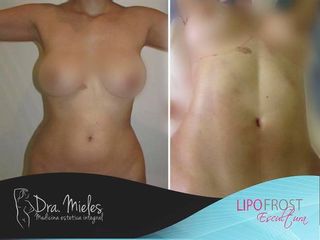LIPOESCULTURA MAS MARCACION ABDOMINAL