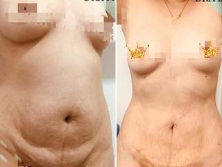 Lipoescultura