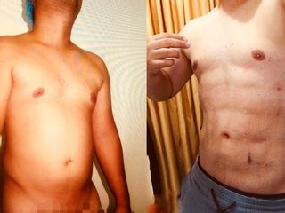 Lipoescultura
