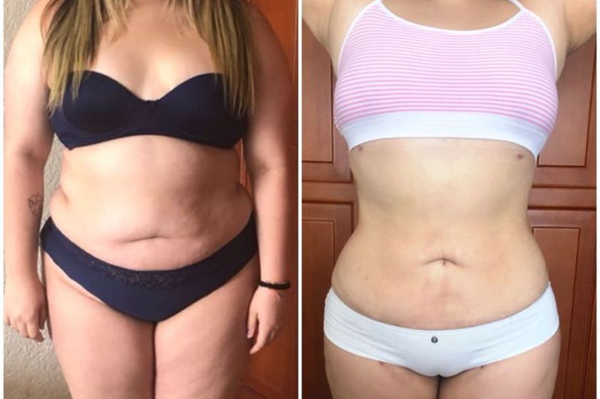 Lipoescultura antes y después - 630513