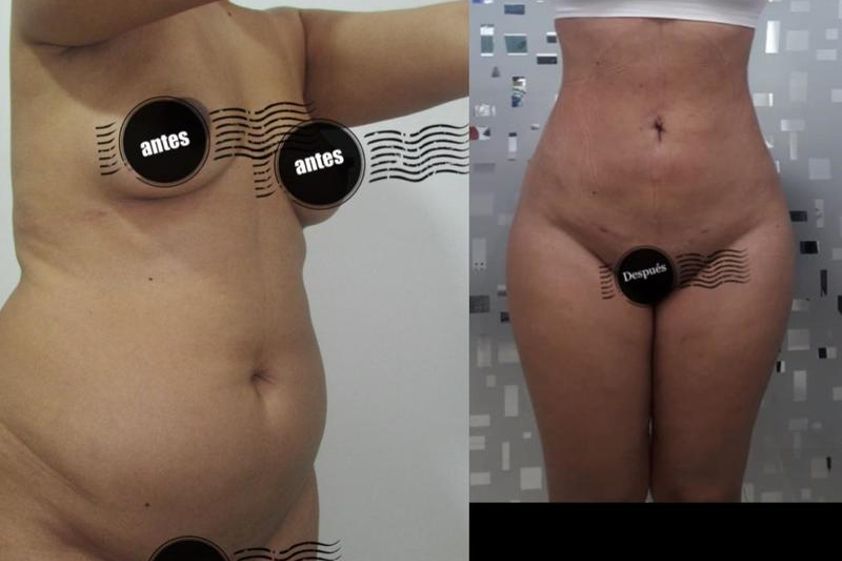 Lipoescultura antes y después - 638760
