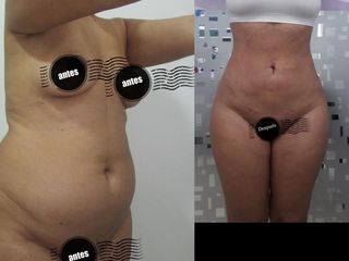 LIPOFROST ESCULTURA